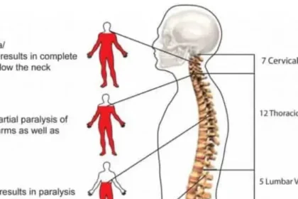 Spinal Cord Injury