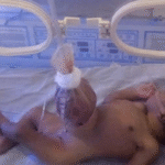 Gastroschisis