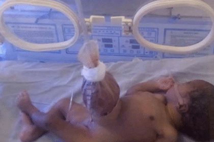 Gastroschisis