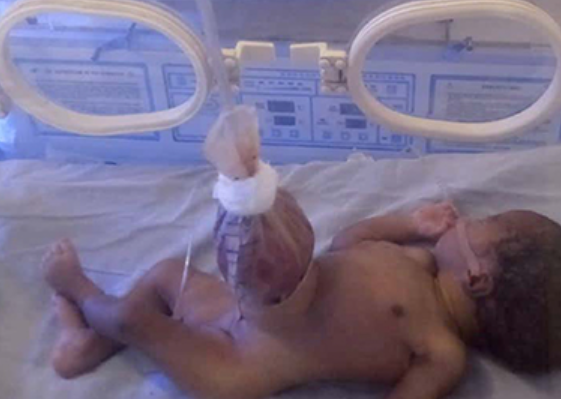 Gastroschisis