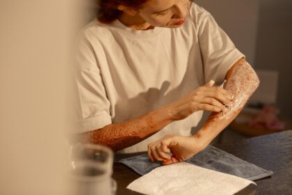 Tattoo removal blisters